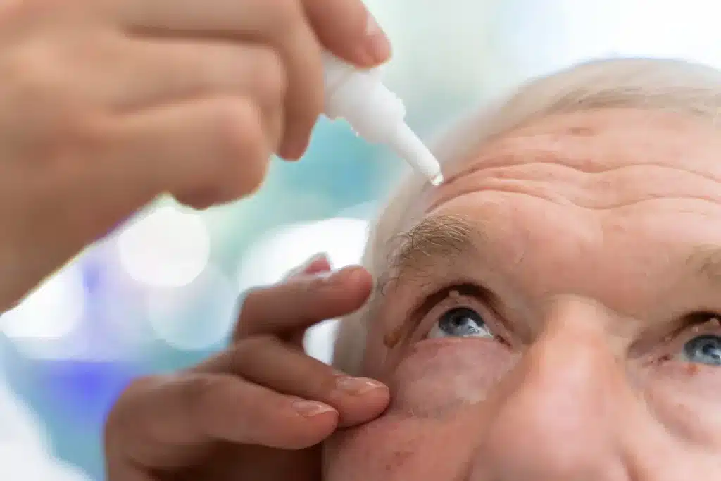 Aplicación de gotas oculares a un paciente antes de realizar una capsulotomía con láser YAG