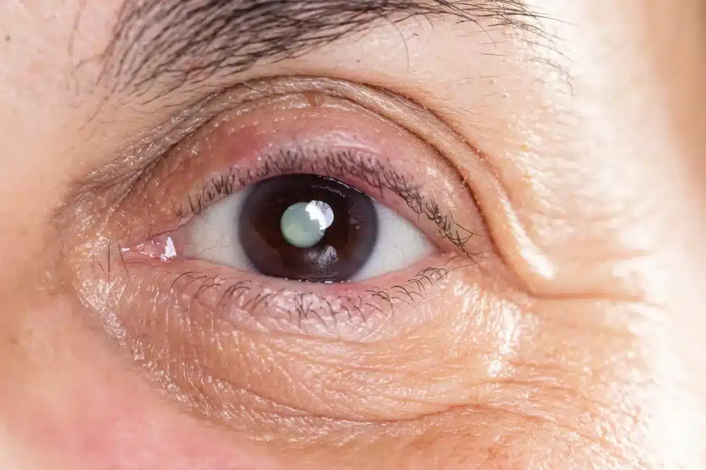Primer plano de un ojo con aspecto de opacidad ocular